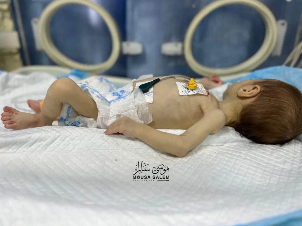 شمالي غزة.. الجوع والمرض ينهش جسد الرضيعة جنيد