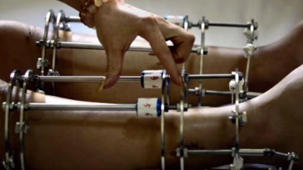 وفاة سعودي بعد خضوعه لعملية “تطويل” في تركيا وفتح تحقيق عاجل وطن