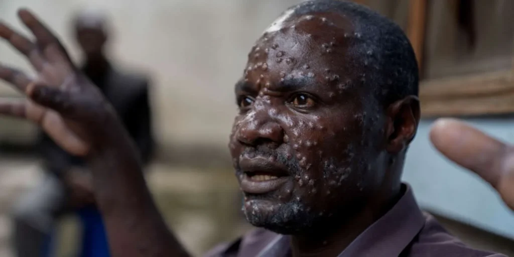 حالة طوارئ صحية في إفريقيا