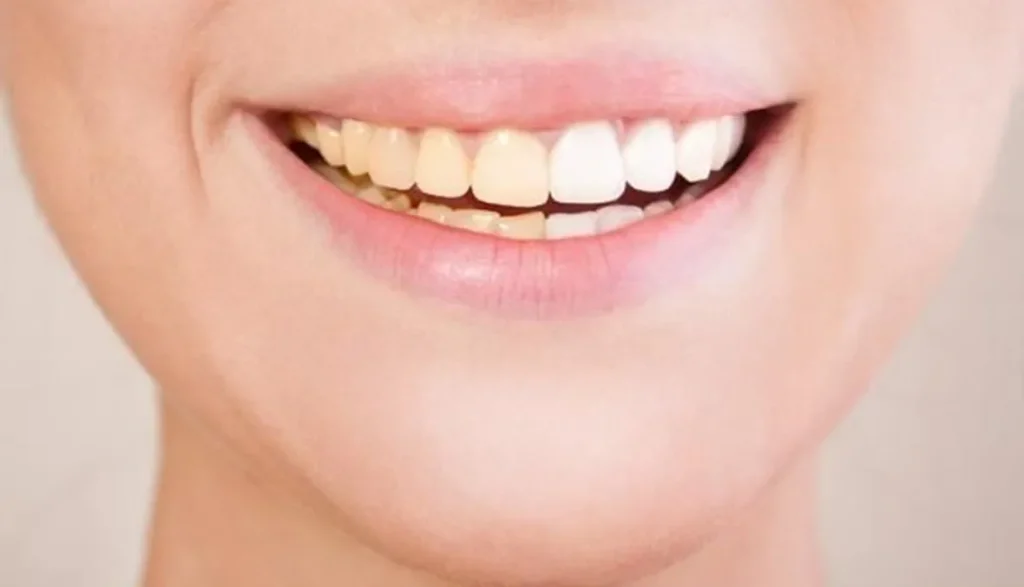 مواد غذائية تغير لون الأسنان