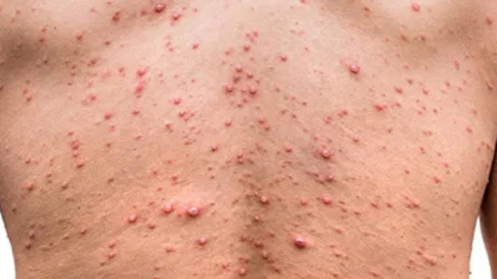 منظمة الصحة العالمية تبقي حالة التأهب القصوى من جدري القردة