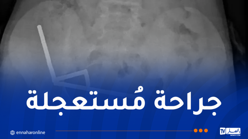 صبي يبتلع 100 مغناطيس!!