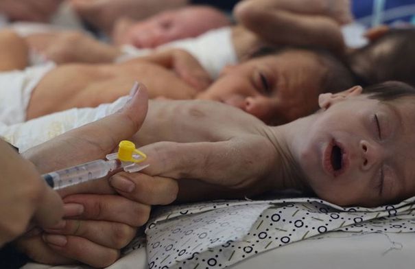 انتشار غير مسبوق لمرض الأنيميا بين الأطفال…