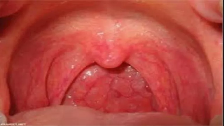 أصوات وإنذارات من جسدك.. إشارات مبكرة قد تدل على سرطان الحلق