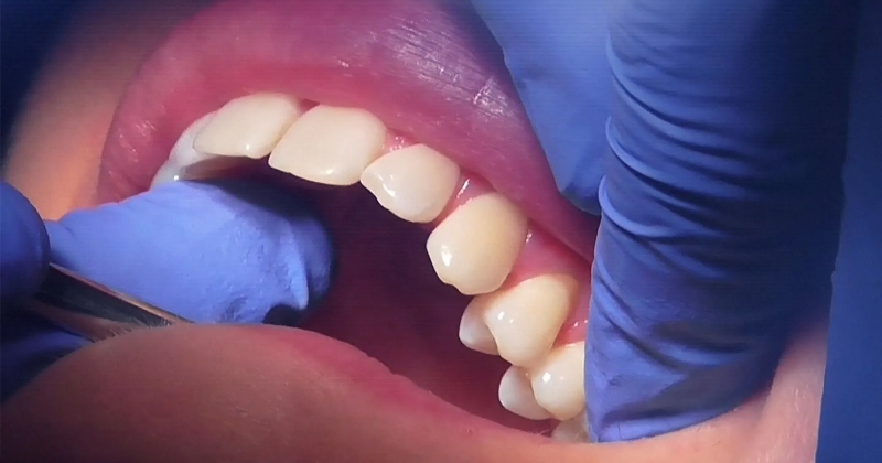 علماء يطورون هلاما لإصلاح الأسنان التالفة دون جراحة