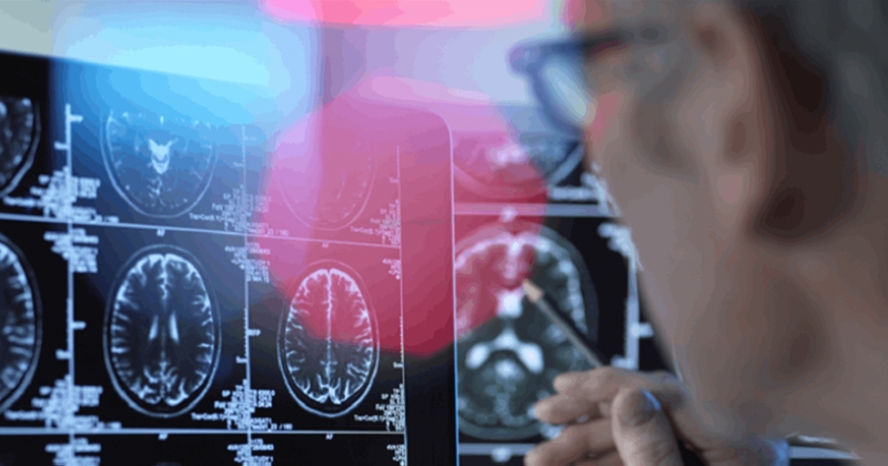 خفض الكوليسترول يقلل خطر الإصابة بالخرف.. دراسة تكشف