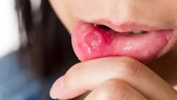 نشرة المرأة والمنوعات | علامة مبكرة لسرطان الفم أو الحلق .. مادة تعيد بناء الأسنان من الداخل وتفتح بابًا لعصر الشفاء الذاتي