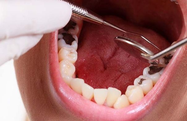 من الدقيقة الأولى.. هكذا يبدأ السكر بإضعاف الأسنان!…