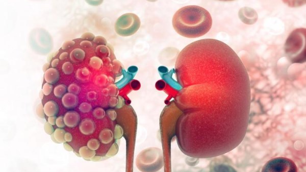 بتخليك لا عارف تاخد مسكنات ولا أدوية.. طرق الوقاية من أمراض الكلى