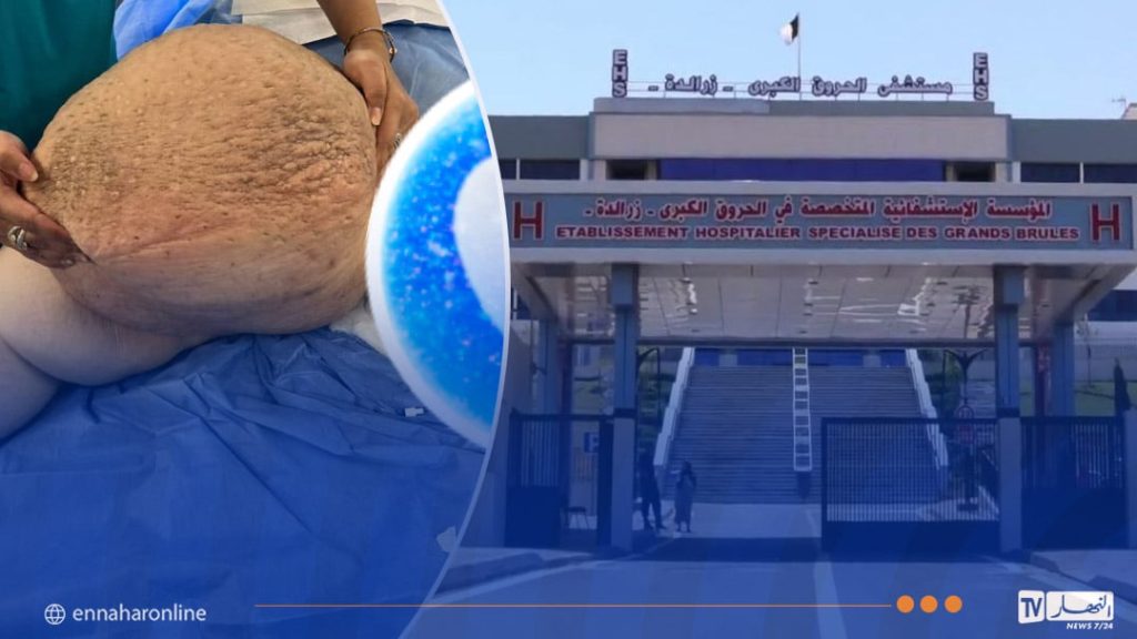 إنجاز طبي نادر بمستشفى الحروق الكبری الدكتور سعيد شيبان